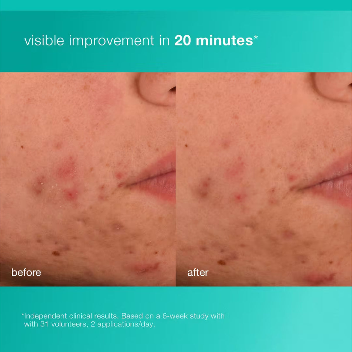 Dermalogica Acne Biotic Moisturizer