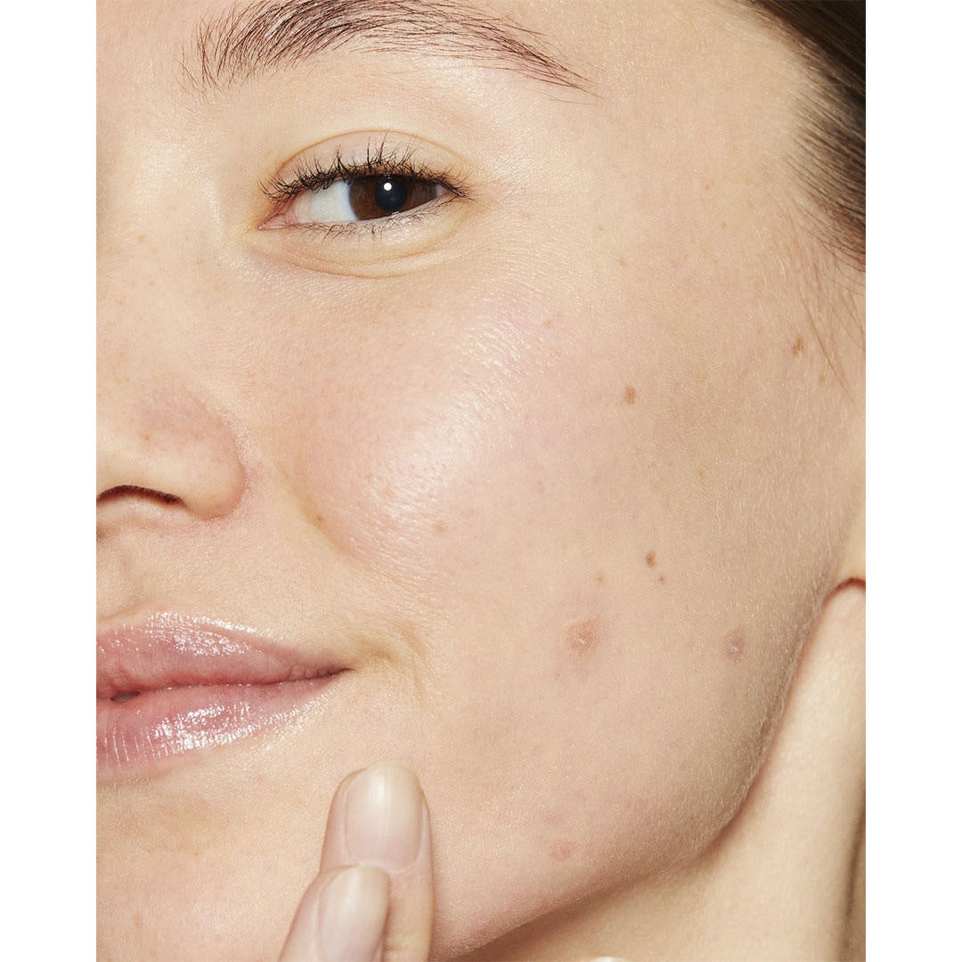 Dermalogica Deep Acne Liquid Patch